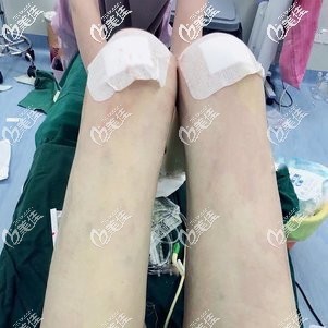 威塑吸脂瘦腿術(shù)后即刻 威塑吸脂瘦腿術(shù)后即刻