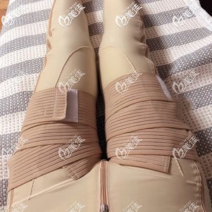 腿部抽脂術(shù)后7天腫脹輕微 腿部抽脂術(shù)后7天腫脹輕微