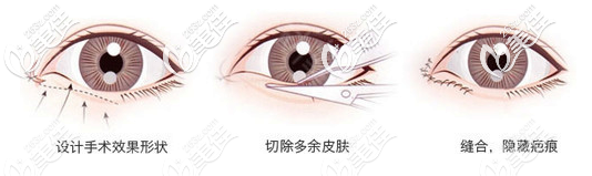 深圳瑞芙臣樊亮醫(yī)生雙眼皮手術(shù)過程演示圖