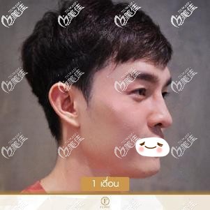 都說(shuō)我在泰國(guó)花17000元做的進(jìn)口硅膠隆鼻手術(shù)很成功 大家來(lái)看這直鼻效果如何