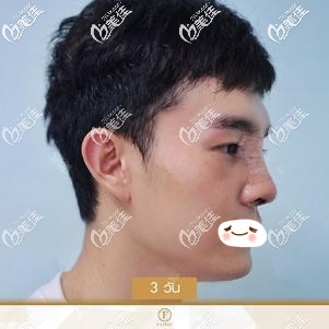 做硅膠隆鼻術(shù)后3天鼻子微腫脹