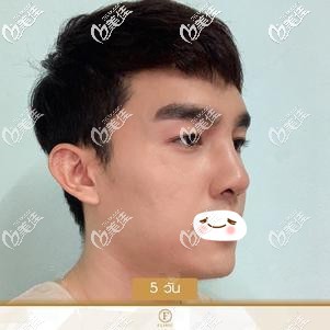 進口硅膠隆鼻術(shù)后5天拆線后鼻子高挺