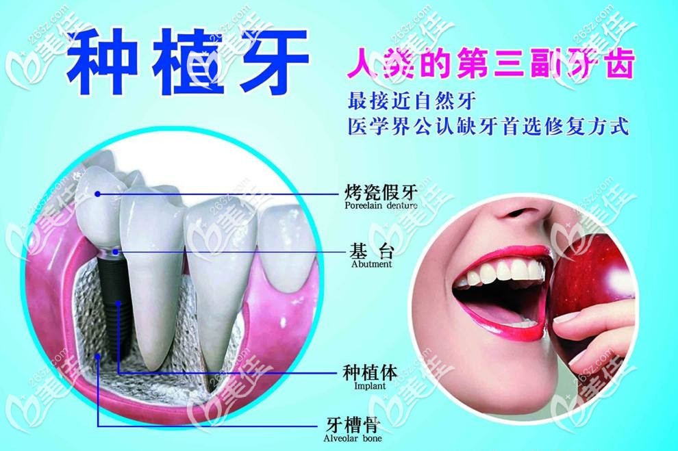 種植牙是人類的第三幅牙齒
