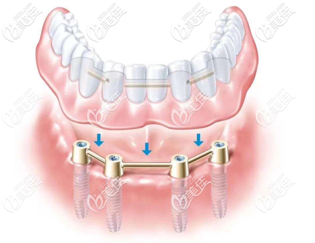 西安全口種植牙價(jià)格是多少錢