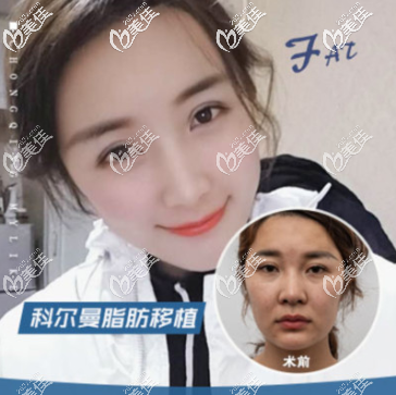 重慶自體脂肪全臉填充案例