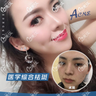 重慶哪個醫(yī)院祛斑好