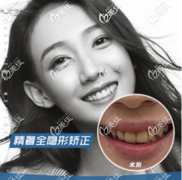 重慶牙齒矯正案例