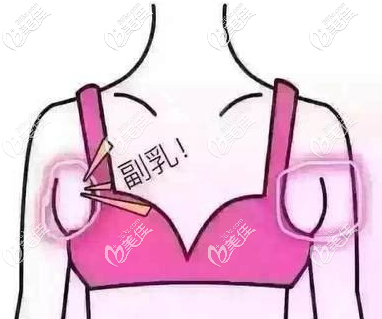 副乳長(zhǎng)什么樣子圖解 副乳長(zhǎng)什么樣子圖解