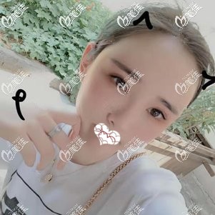 術(shù)后15天面部線條更加流暢柔和 術(shù)后15天面部線條更加流暢柔和