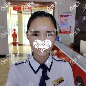 自體脂肪填充蘋果肌術(shù)后5天全臉微腫 自體脂肪填充蘋果肌術(shù)后5天全臉微腫