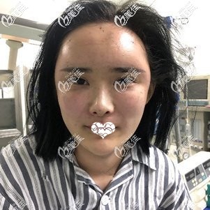 剛做完脂肪填充面部手術(shù)后腫脹感較強(qiáng) 剛做完脂肪填充面部手術(shù)后腫脹感較強(qiáng)