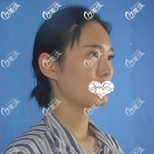 術(shù)前面部凹陷 術(shù)前面部凹陷