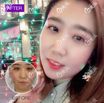 遵義韓美能祛痘嗎