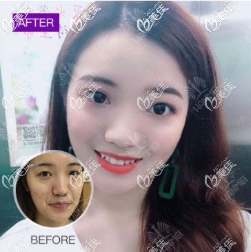 遵義韓美自體脂肪全臉填充