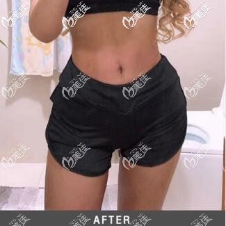 花3萬多元體驗了泰國藝術整形外科威塑吸脂瘦腰腹大腿，效果確實好我很滿意！