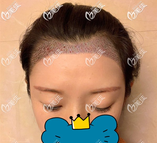 發(fā)際線種植后即刻效果 發(fā)際線種植后即刻效果