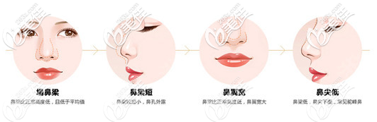 汕頭ido整形醫(yī)院隆鼻手術(shù) 汕頭ido整形醫(yī)院隆鼻手術(shù)