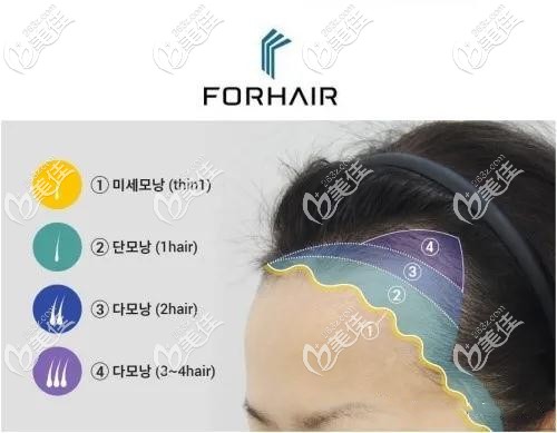 發(fā)際線種植分為四個步驟種植 發(fā)際線種植分為四個步驟種植