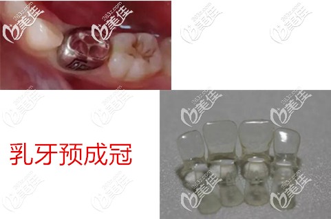 乳牙金屬和透明預成冠