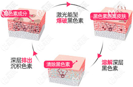 激光去黑眼圈原理示意圖 激光去黑眼圈原理示意圖