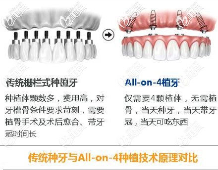 傳統(tǒng)種牙與ALL-ON-4種植技術(shù)對(duì)比 傳統(tǒng)種牙與ALL-ON-4種植技術(shù)對(duì)比