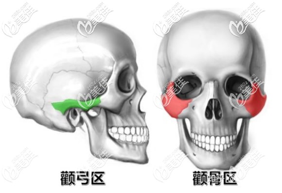 顴骨和顴弓的區(qū)別 顴骨和顴弓的區(qū)別