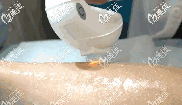 冰點脫毛的操作