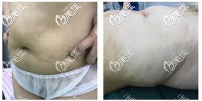 腰腹吸脂手術前 腰腹吸脂手術前