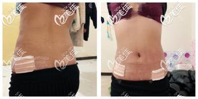腰腹環(huán)吸后4天出院后的恢復效果 腰腹環(huán)吸后4天出院后的恢復效果