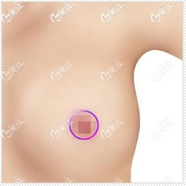 環(huán)狀乳暈切口法 環(huán)狀乳暈切口法