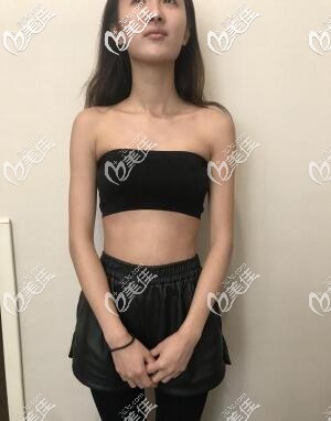 術(shù)前我的胸就是這么平 術(shù)前我的胸就是這么平