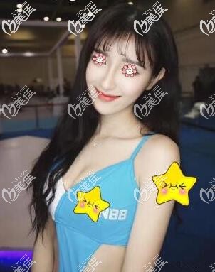 去泰國(guó)咖蒙KAMOL醫(yī)院做300cc曼托假體胸感觸特深的一點(diǎn)是他們的型號(hào)和尺寸很全