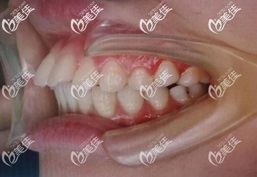 門牙前突矯正前的照片 門牙前突矯正前的照片