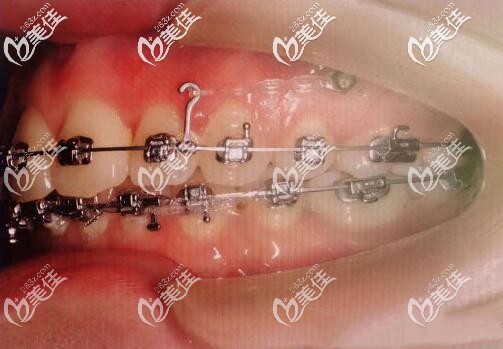 戴進口金屬自鎖托槽矯正齙牙 戴進口金屬自鎖托槽矯正齙牙