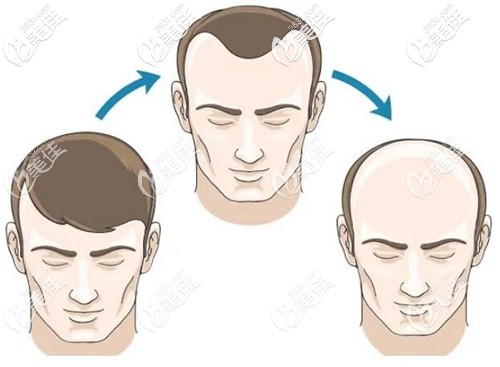 男士M型兩額角脫發(fā) 男士M型兩額角脫發(fā)