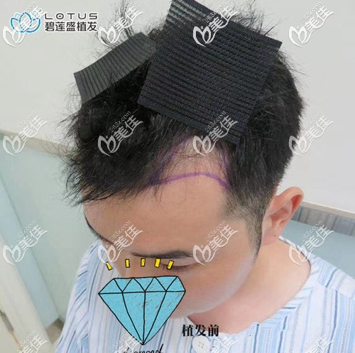 植發(fā)補(bǔ)額角手術(shù)前方案設(shè)計(jì) 植發(fā)補(bǔ)額角手術(shù)前方案設(shè)計(jì)