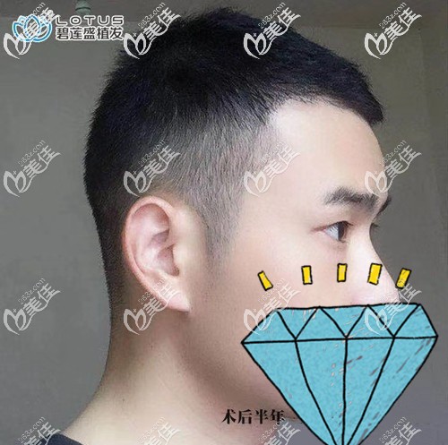 M型兩額角脫發(fā)長不出來了不用怕!通過頭發(fā)種植補額角即可填補空白