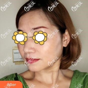 跟大家分享我親身做熱瑪吉全面部提升抗衰的經(jīng)歷，效果比我預(yù)料的還要好！