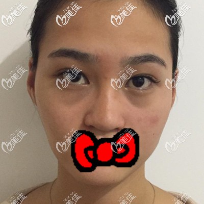 做自體脂肪面部填充術(shù)前照 做自體脂肪面部填充術(shù)前照