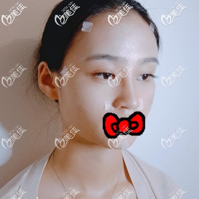 術(shù)后第3天 術(shù)后第3天