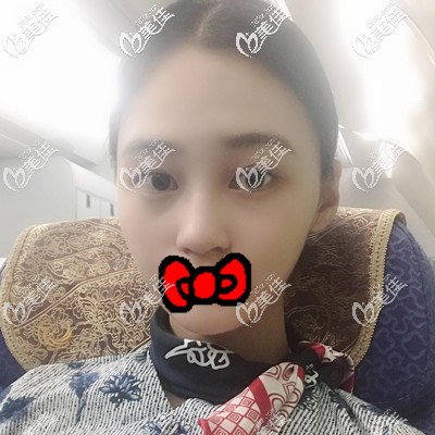 脂肪豐面部術(shù)后半個(gè)月效果展示 脂肪豐面部術(shù)后半個(gè)月效果展示