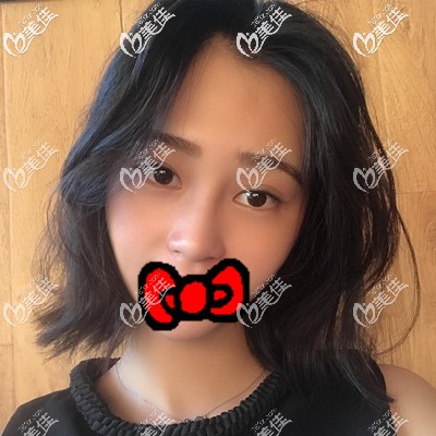 我全臉填充用了70毫升脂肪，三個月后面部飽滿分享對比圖給你參考