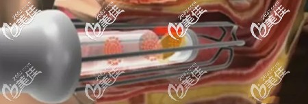 分析激光縮陰的原理 分析激光縮陰的原理