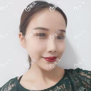 以我注射玻尿酸墊下巴的真實(shí)經(jīng)歷來看選擇喬雅登好還是絲麗好