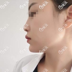 剛注射完喬雅登玻尿酸墊下巴后有點腫脹