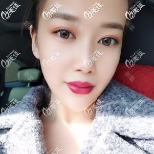 注射喬雅登玻尿酸墊下巴3天慢慢消腫