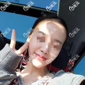 注射玻尿酸墊下巴術(shù)后一周效果明顯