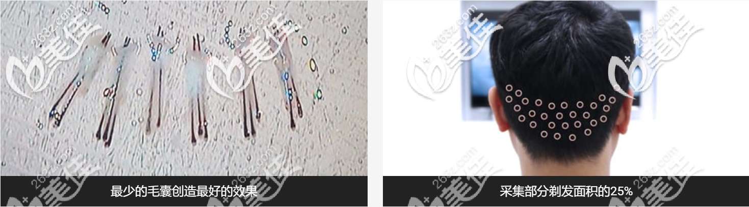 韓國植發(fā)好還是國內(nèi)好？韓國植發(fā)優(yōu)勢