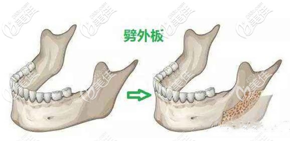 下頜角劈外板效果圖 下頜角劈外板效果圖