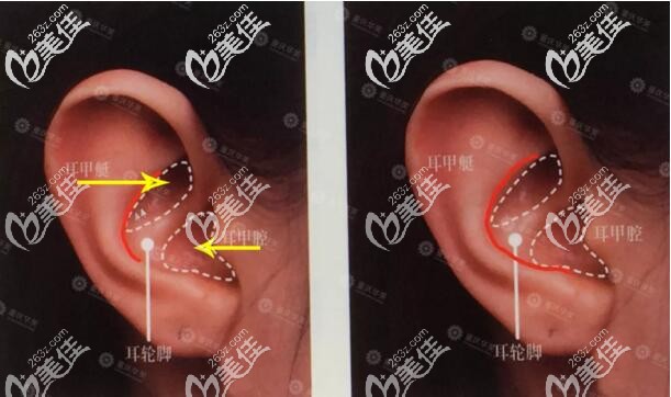 取耳軟骨的位置 取耳軟骨的位置